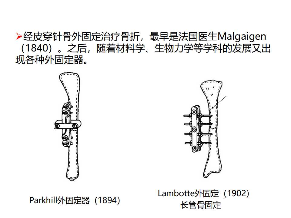 骨科常见的外固定架及其临床应用