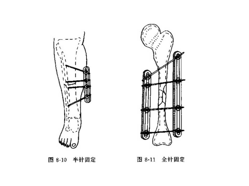 骨科常见的外固定架及其临床应用