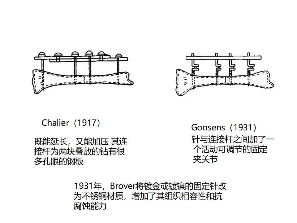 骨科常见的外固定架及其临床应用