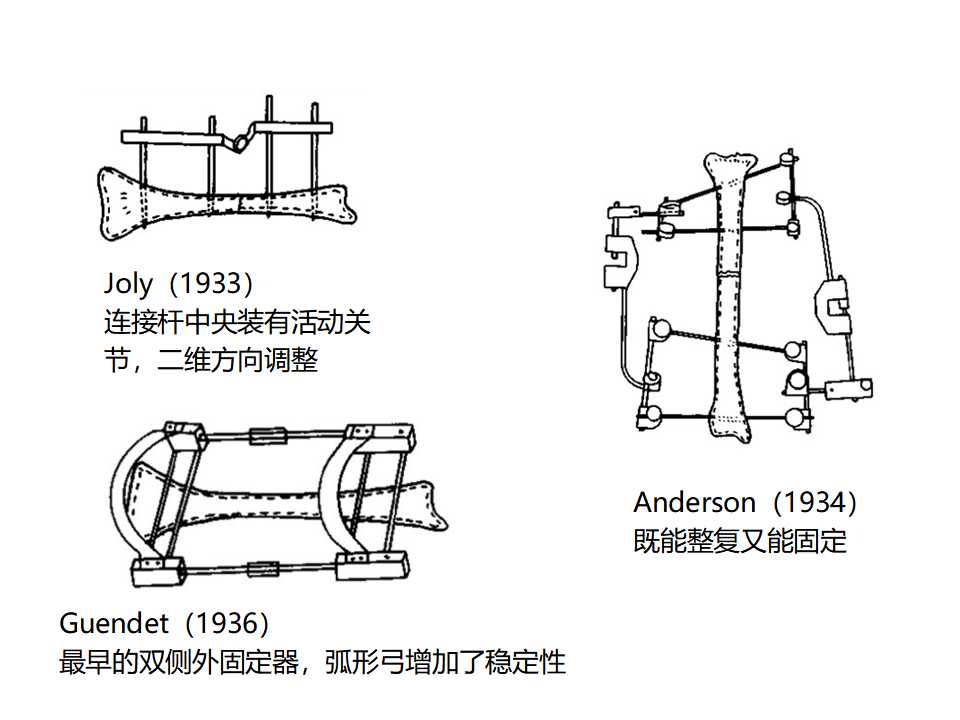 骨科常见的外固定架及其临床应用