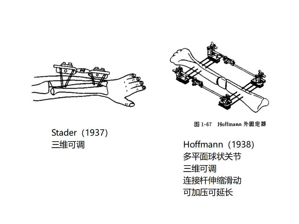 骨科常见的外固定架及其临床应用