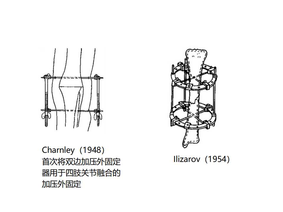 骨科常见的外固定架及其临床应用