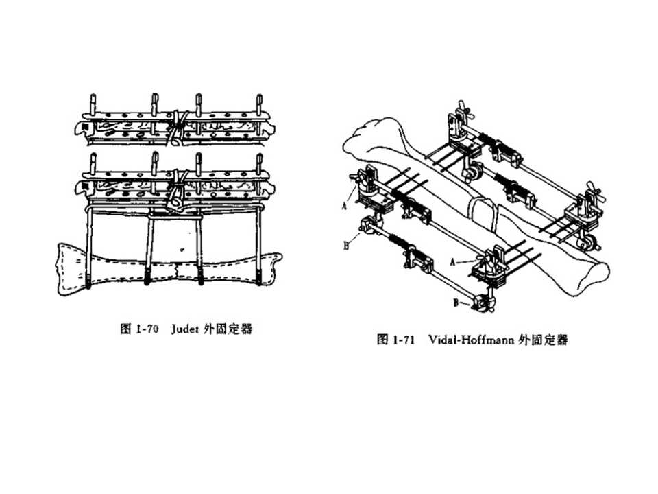 骨科常见的外固定架及其临床应用