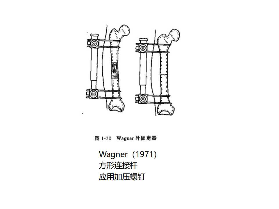 骨科常见的外固定架及其临床应用