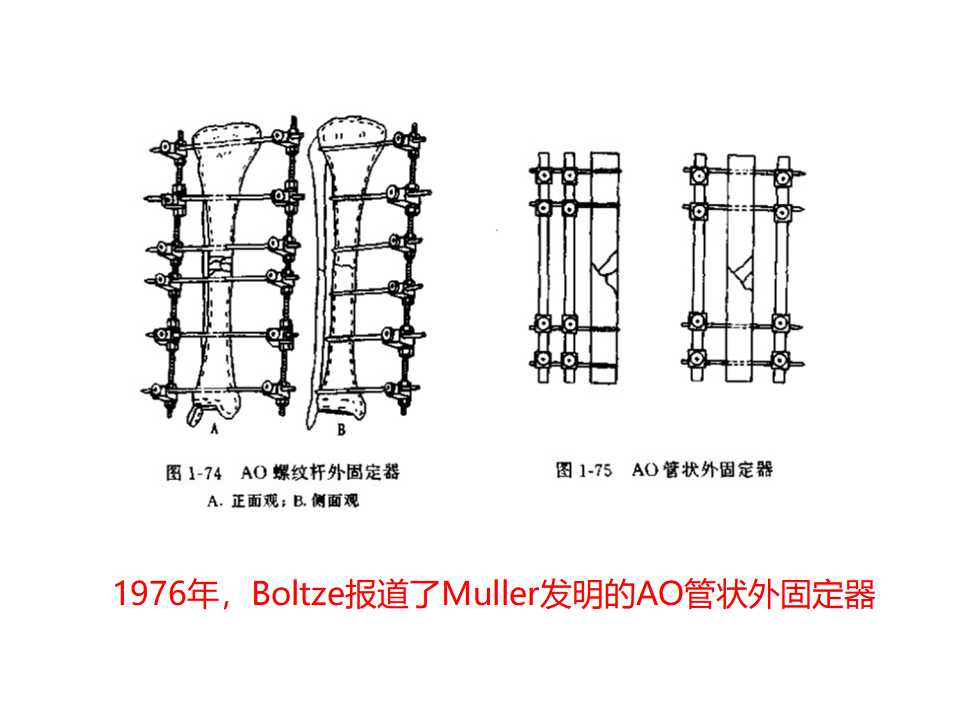 骨科常见的外固定架及其临床应用