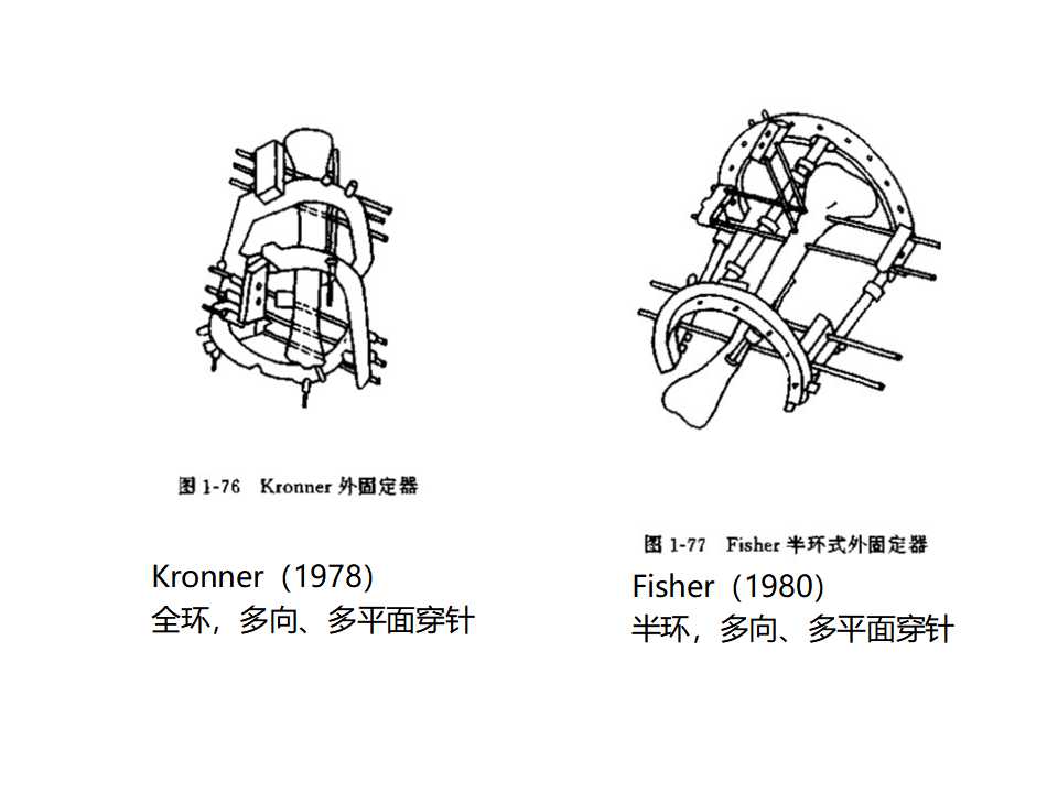 骨科常见的外固定架及其临床应用