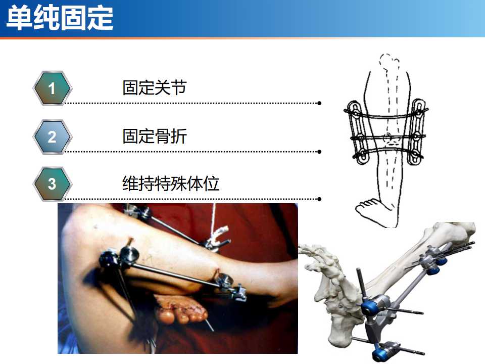 骨科常见的外固定架及其临床应用