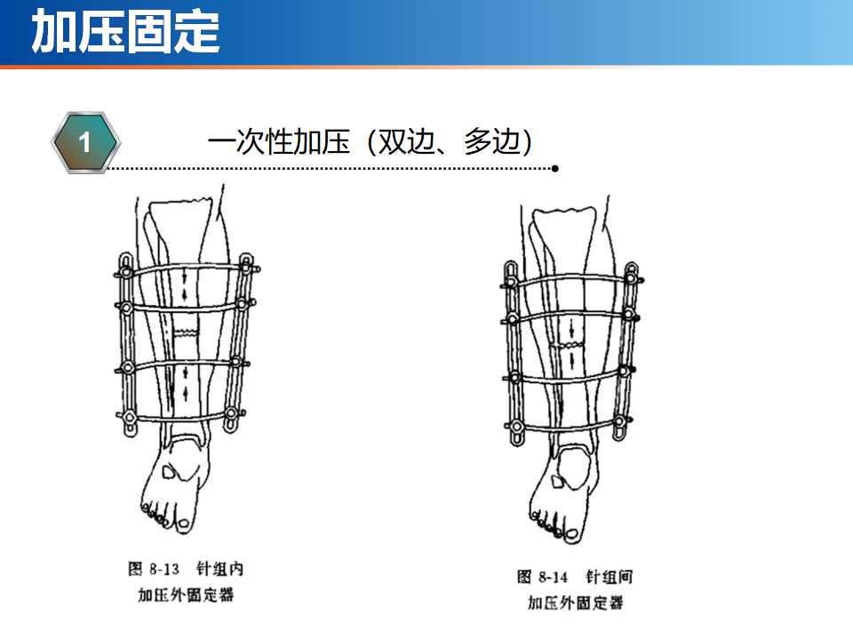 骨科常见的外固定架及其临床应用