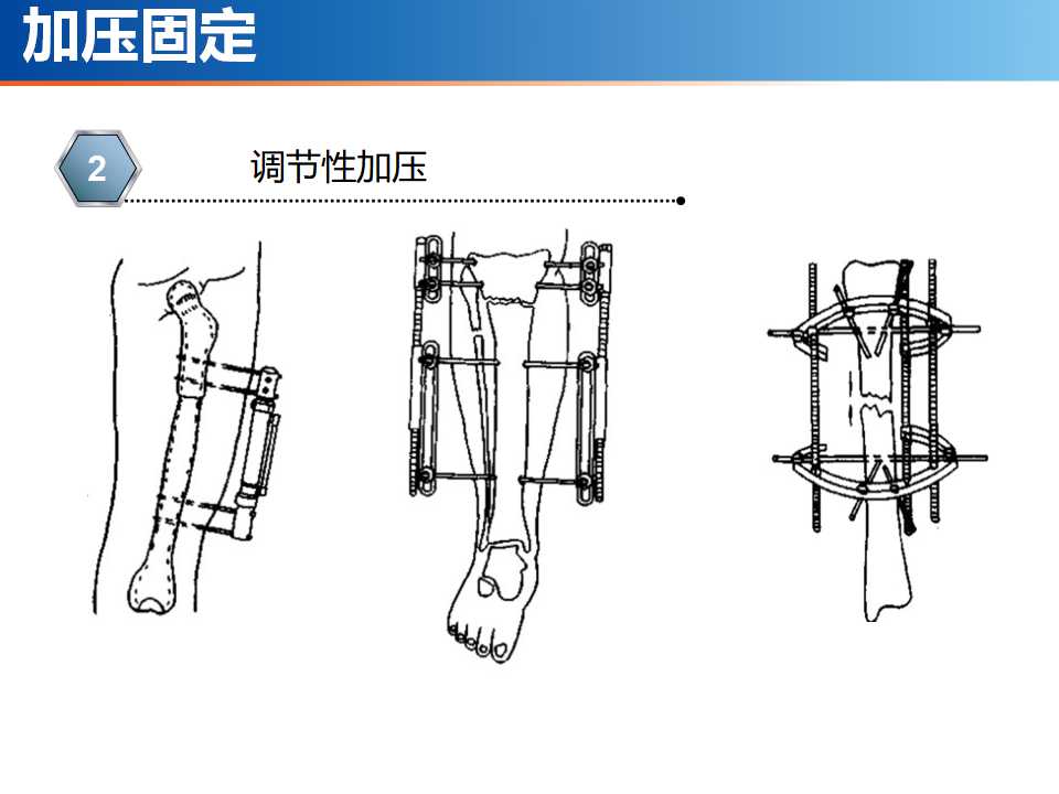 骨科常见的外固定架及其临床应用