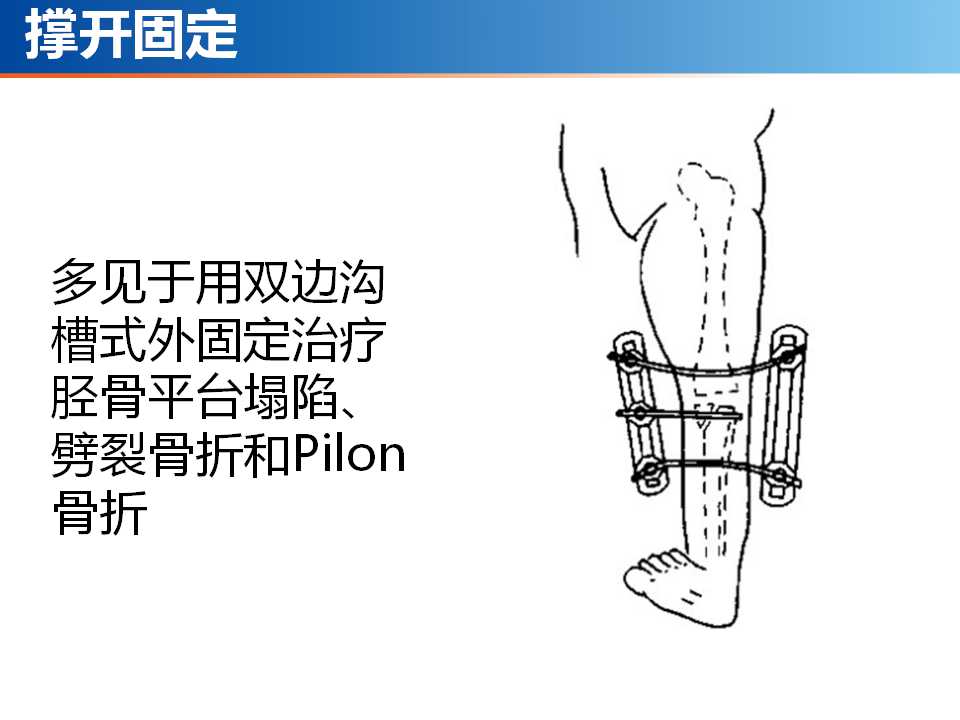 骨科常见的外固定架及其临床应用