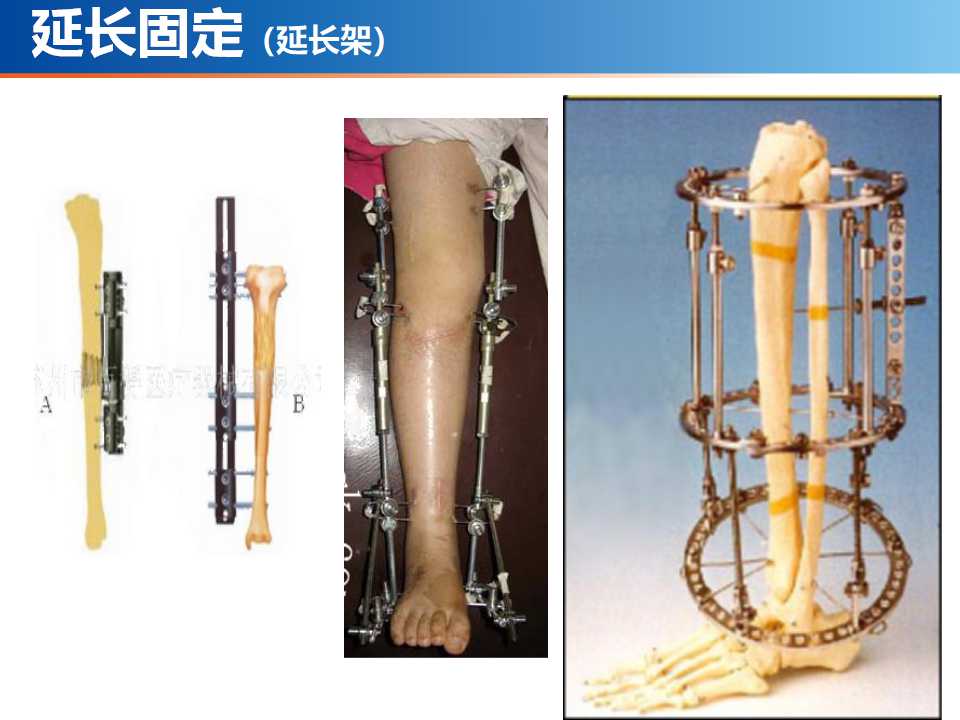 骨科常见的外固定架及其临床应用