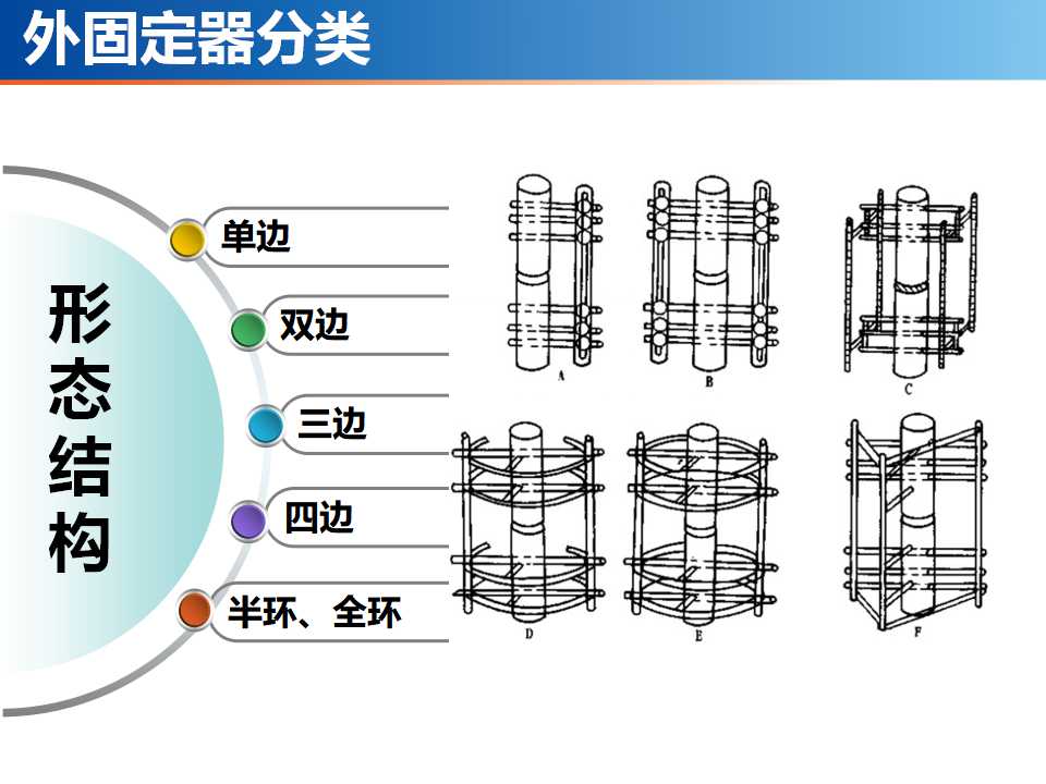 骨科常见的外固定架及其临床应用