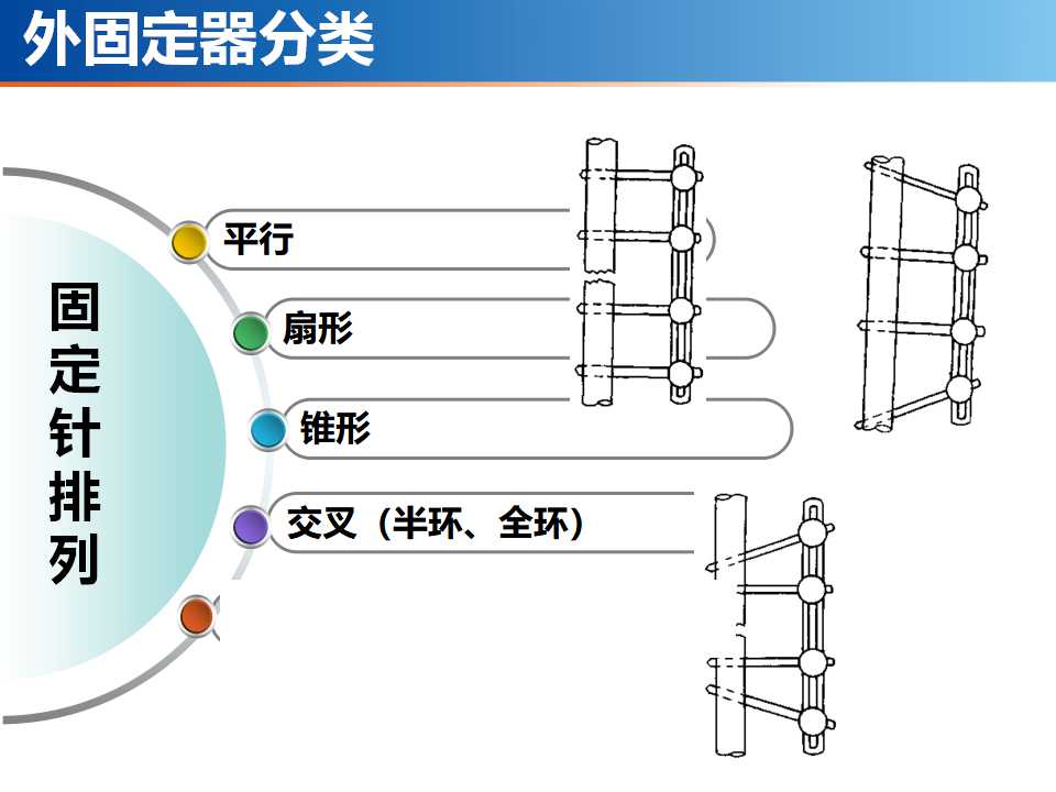 骨科常见的外固定架及其临床应用