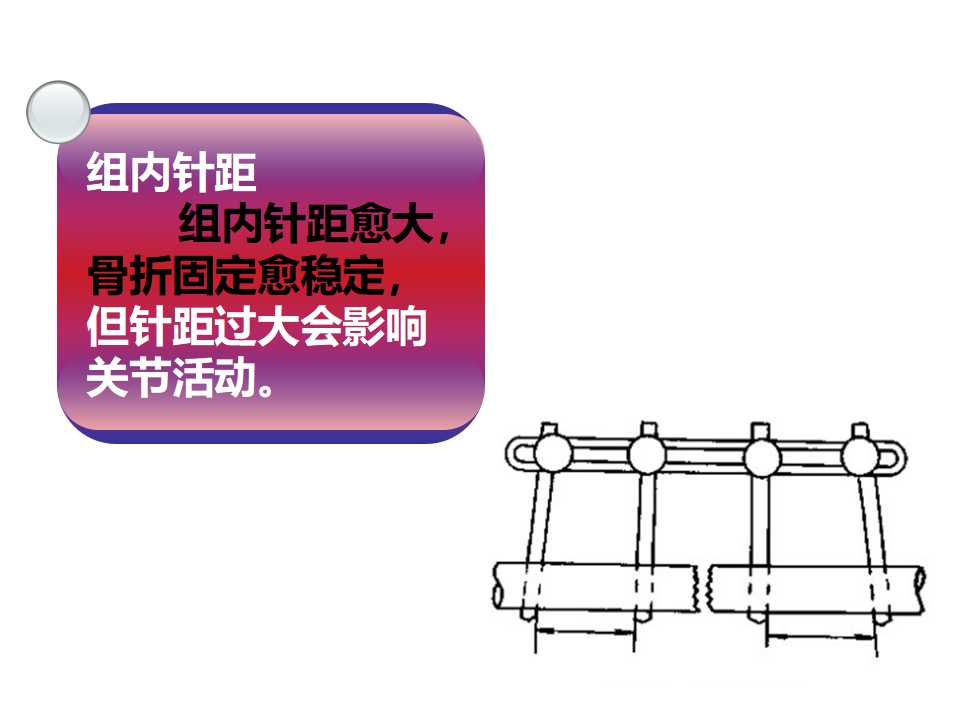 骨科常见的外固定架及其临床应用