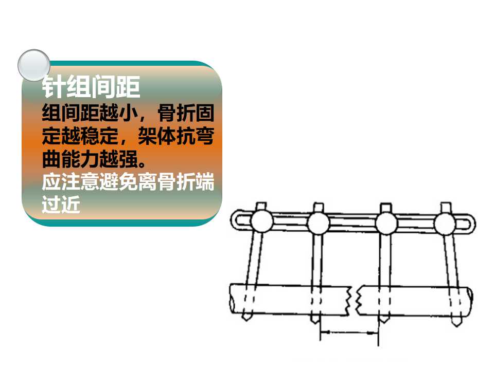 骨科常见的外固定架及其临床应用