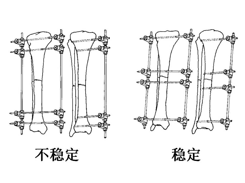 骨科常见的外固定架及其临床应用