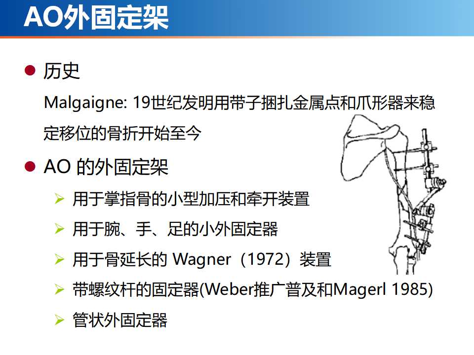 骨科常见的外固定架及其临床应用