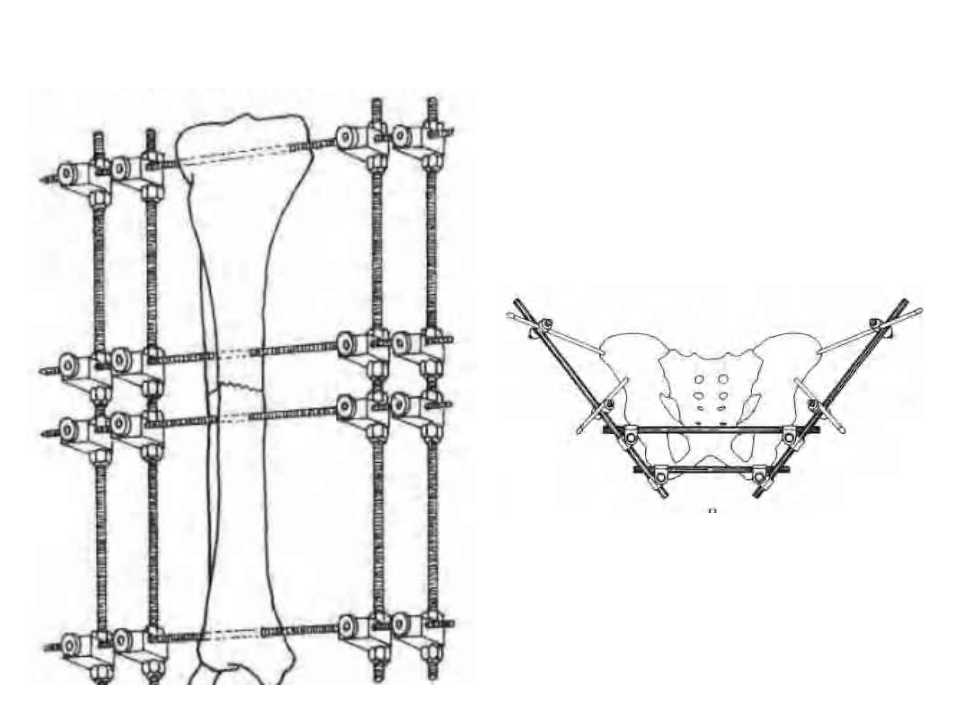 骨科常见的外固定架及其临床应用