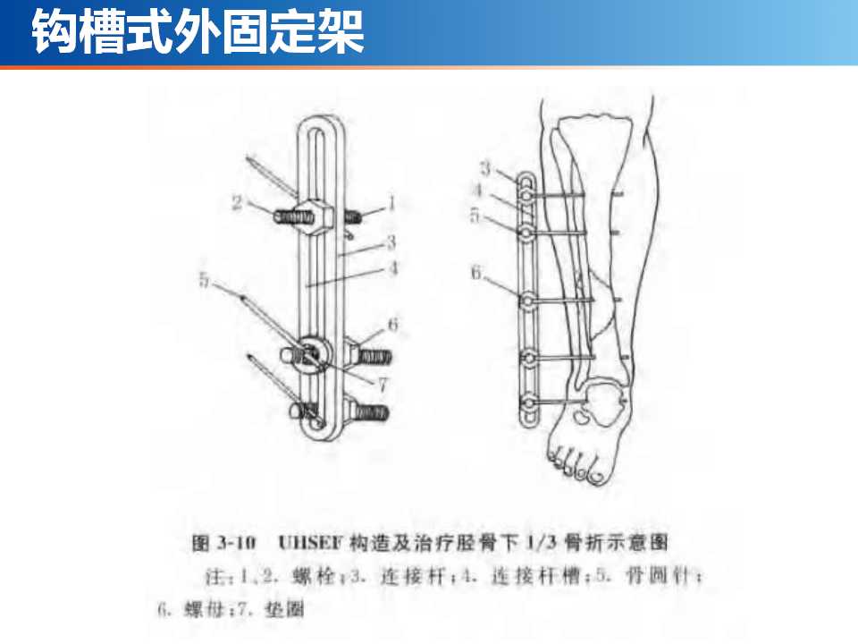 骨科常见的外固定架及其临床应用