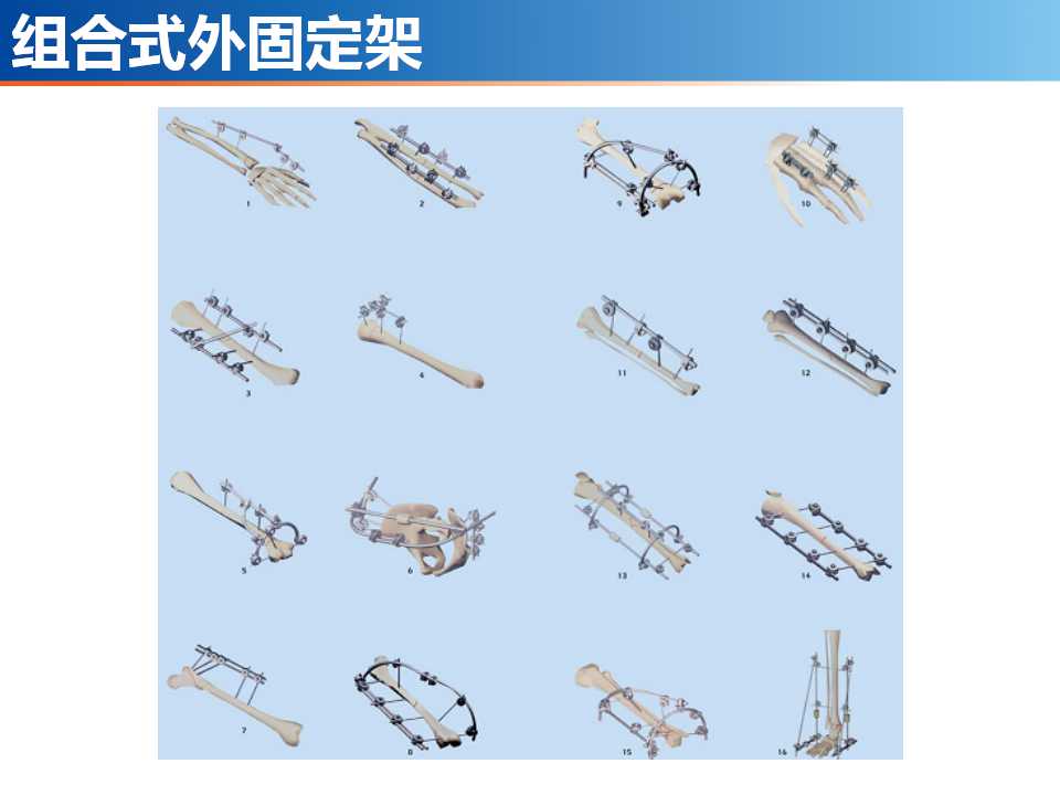 骨科常见的外固定架及其临床应用