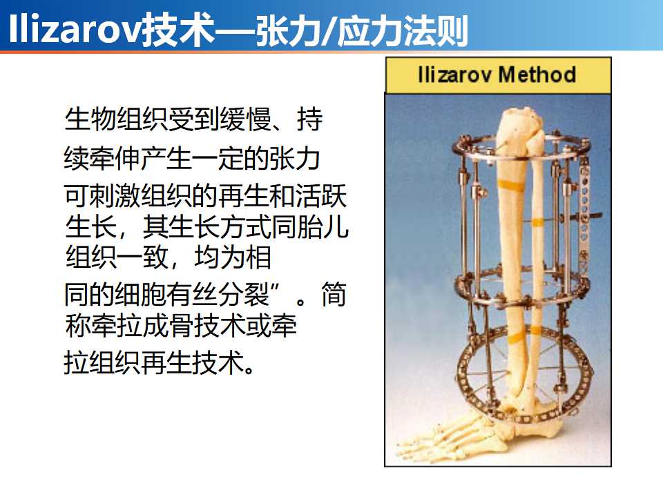 骨科常见的外固定架及其临床应用