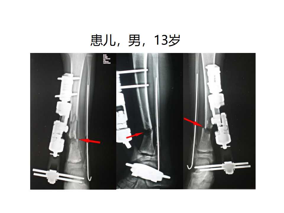 骨科常见的外固定架及其临床应用