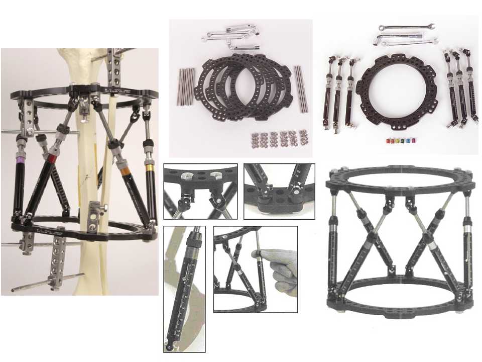 骨科常见的外固定架及其临床应用