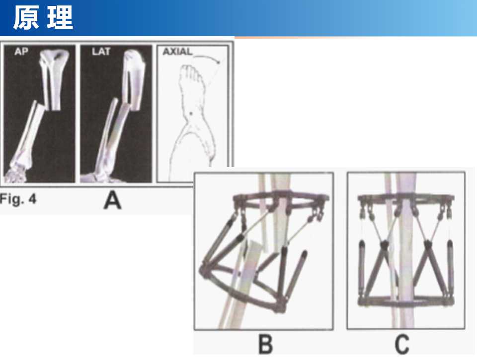 骨科常见的外固定架及其临床应用