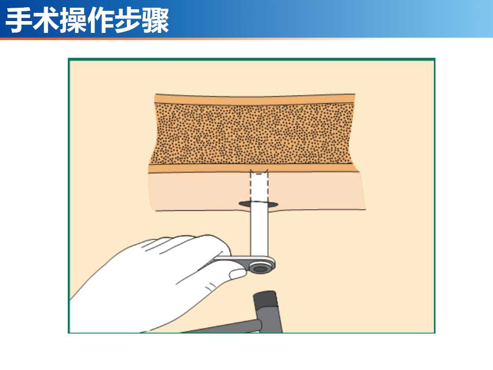 骨科常见的外固定架及其临床应用