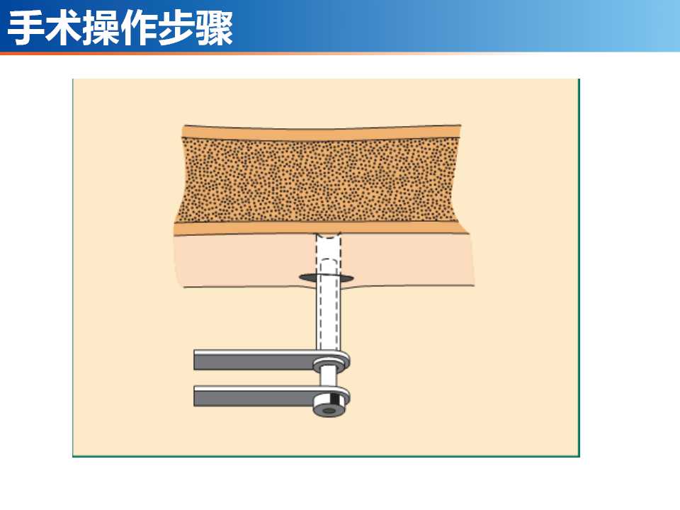 骨科常见的外固定架及其临床应用