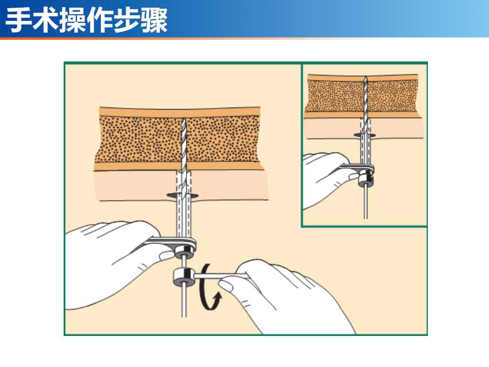 骨科常见的外固定架及其临床应用