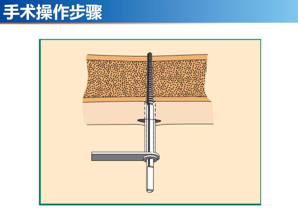 骨科常见的外固定架及其临床应用