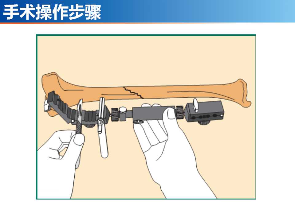 骨科常见的外固定架及其临床应用