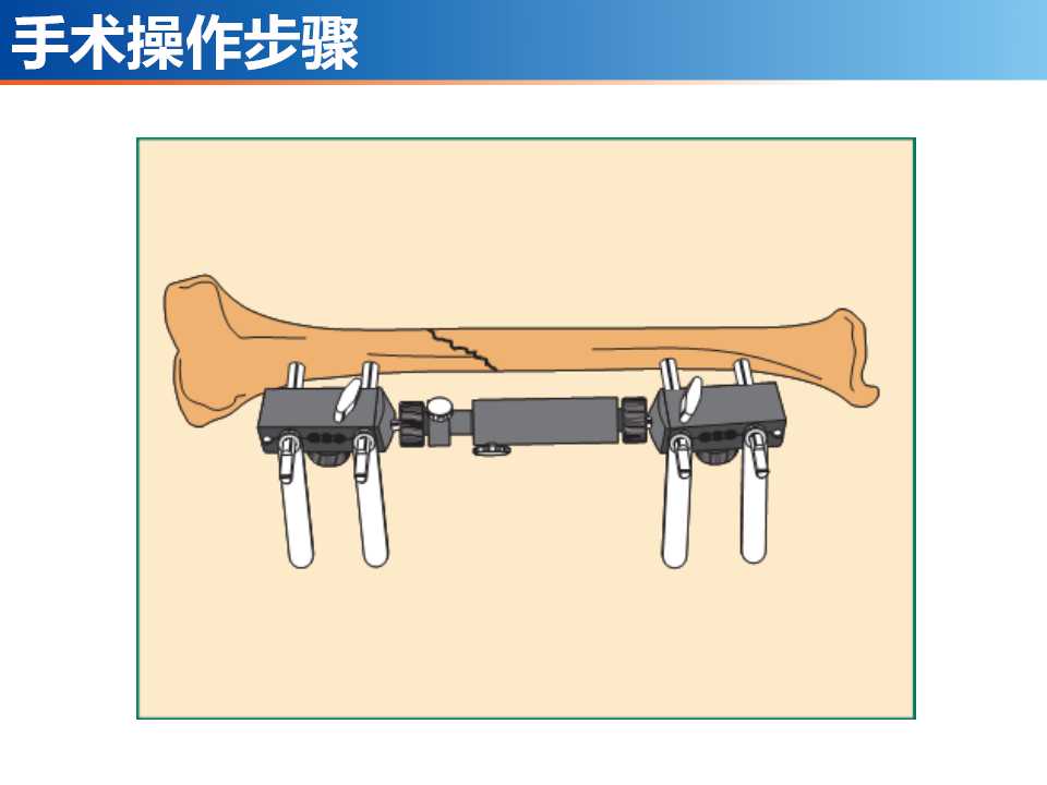 骨科常见的外固定架及其临床应用