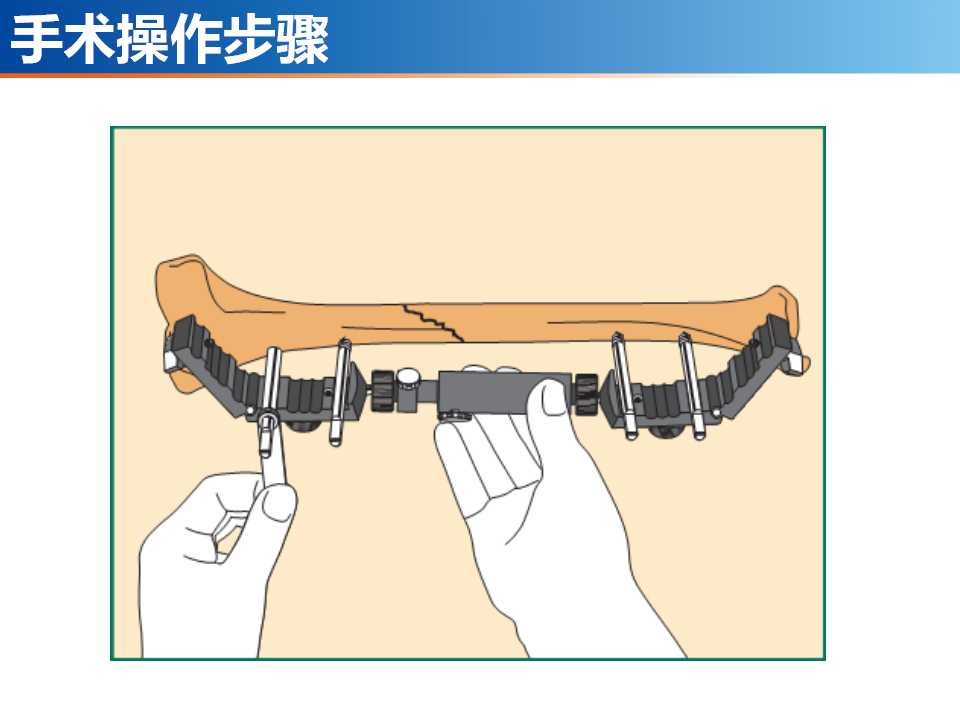 骨科常见的外固定架及其临床应用