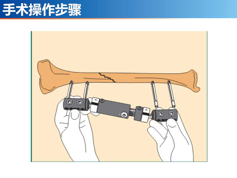 骨科常见的外固定架及其临床应用