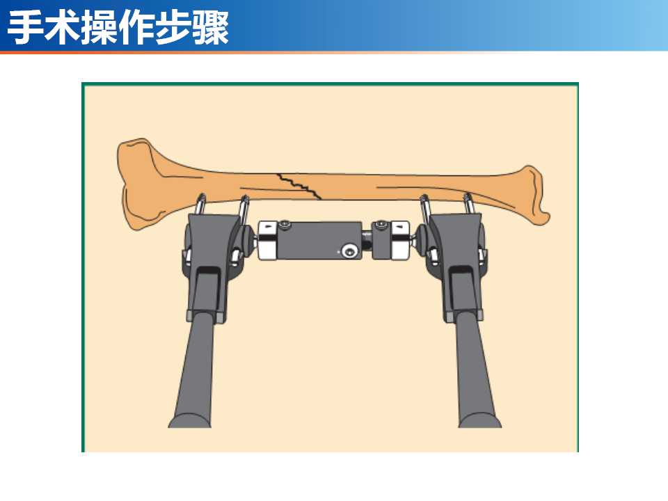 骨科常见的外固定架及其临床应用