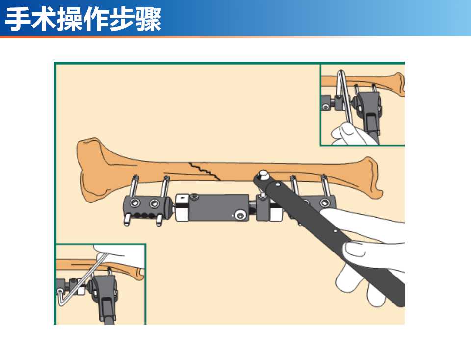 骨科常见的外固定架及其临床应用