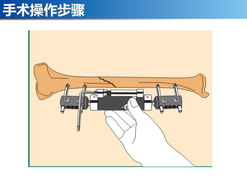 骨科常见的外固定架及其临床应用