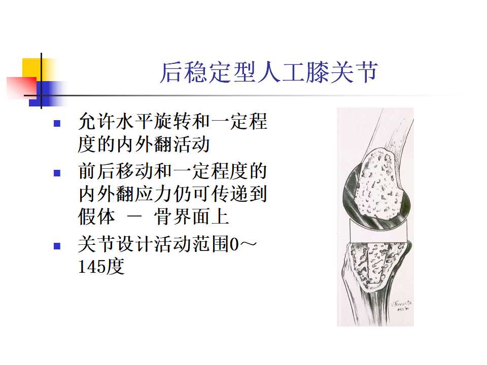 全膝关节置换的手术要求及技巧