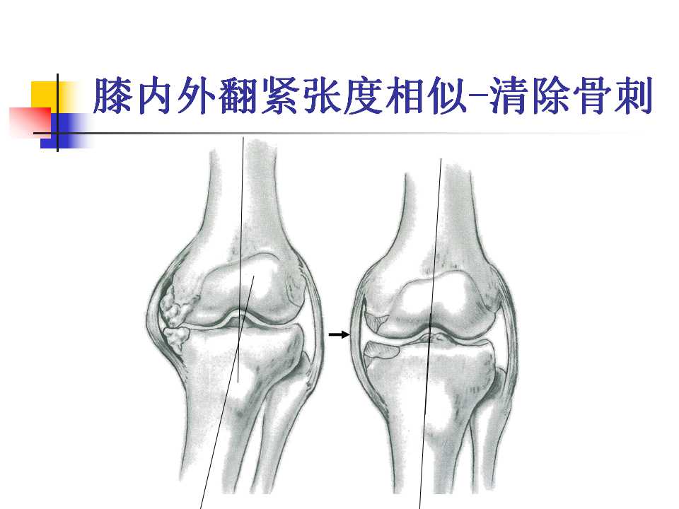 全膝关节置换的手术要求及技巧