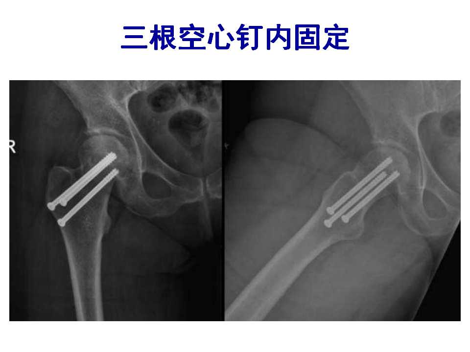 骨质疏松性骨折的手术及药物治疗