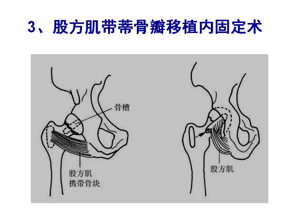 骨质疏松性骨折的手术及药物治疗