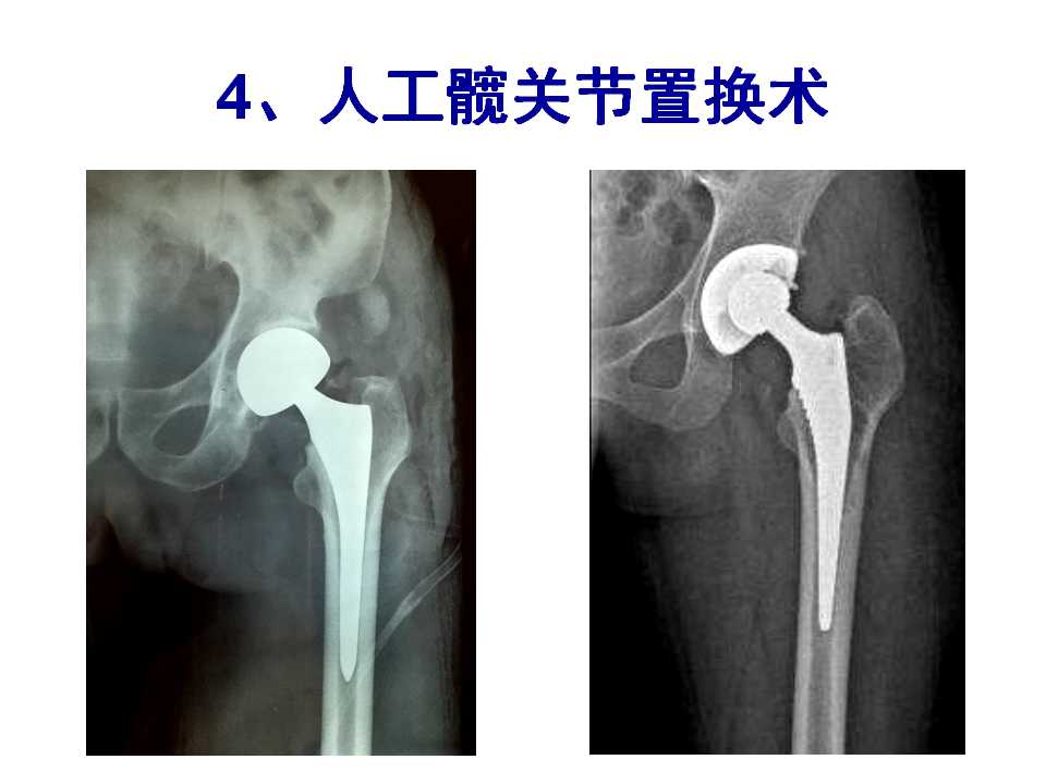 骨质疏松性骨折的手术及药物治疗