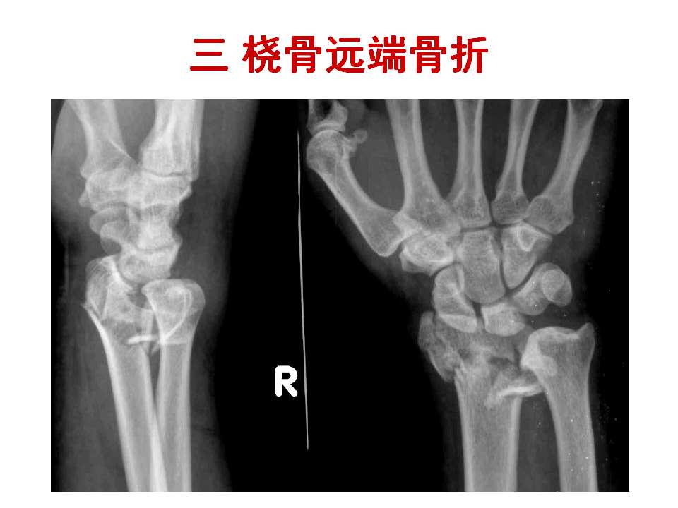 骨质疏松性骨折的手术及药物治疗