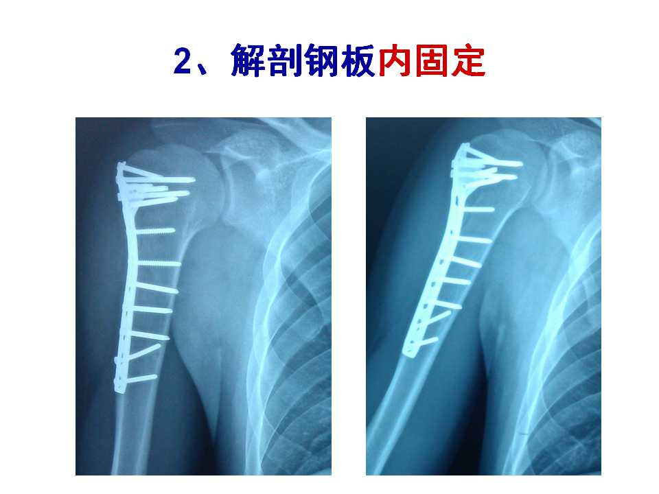 骨质疏松性骨折的手术及药物治疗