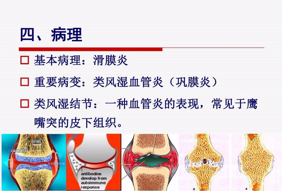 类风湿性关节炎的临床表现及治疗