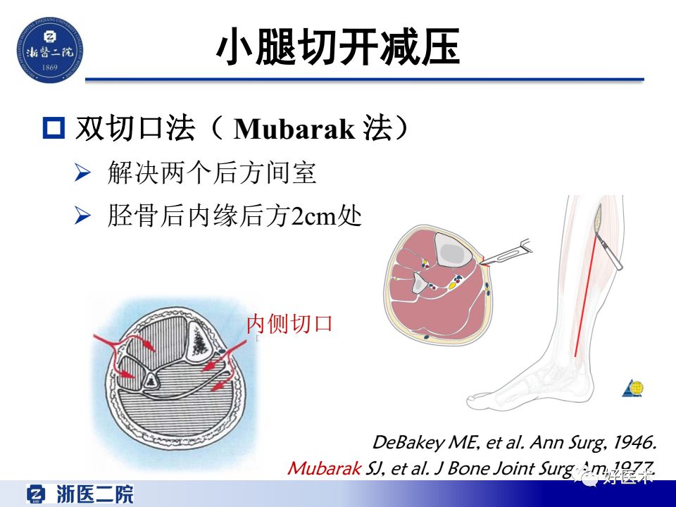 骨筋膜室综合征的诊治策略