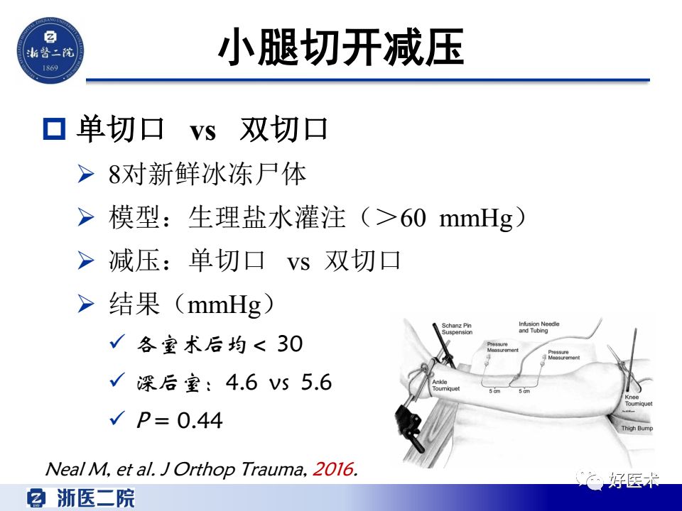 骨筋膜室综合征的诊治策略