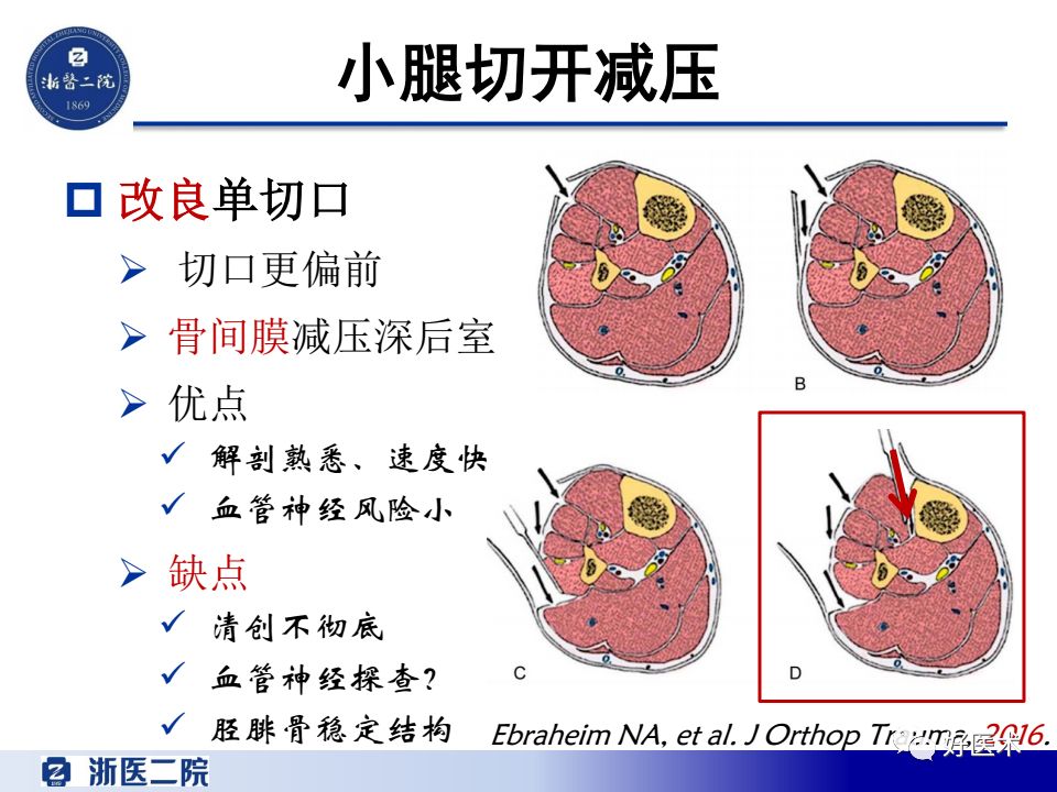 骨筋膜室综合征的诊治策略